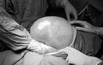Cụ bà 64 tuổi có khối u buồng trứng nặng như trẻ 10 tháng tuổi