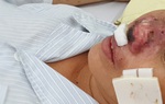 Bệnh Whitmore do “vi khuẩn ăn thịt người” gây ra đang quay trở lại, đây mọi điều bạn bạn cần biết