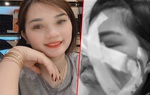 Cấy mỡ tự thân làm chị em lao đao: Người mặt sưng phù, người qua đời trên bàn phẫu thuật