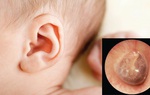 Điều trị viêm tai giữa có mủ như thế nào?