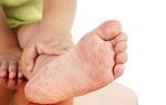 Bệnh tay chân miệng cấp độ 1 ở trẻ nhỏ: Biểu hiện, điều trị và phòng tránh