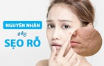 Biết được lý do da mặt sẹo rỗ, bạn sẽ không dám nặn mụn nữa