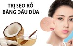 Cách trị sẹo rỗ trên mặt lâu năm tại nhà hiệu quả nhanh nhất