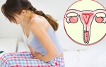 Nhóm phụ nữ có nguy cơ mắc ung thư cổ tử cung cao, kiểm tra để chủ động thăm khám