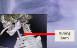 Bé trai bị thủng thực quản, suy hô hấp nặng do hóc xương lươn