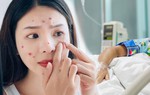 Viêm nội sọ chỉ vì nặn mụn: Những vùng mụn nguy hiểm chị em cần biết