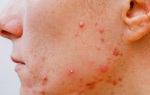 Đừng chủ quan với mụn mọc ngược 