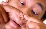 Nhiễm trùng nội sọ do nặn mụn sai cách ở vùng tam giác chết trên mặt
