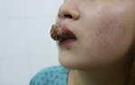 Môi sưng phù sau xăm ở thẩm mỹ viện, người phụ nữ đến bệnh viện cầu cứu