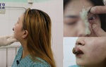 Làm đẹp đón Tết, người suýt mù mắt vì tiêm filler, người môi mưng mủ vì xăm
