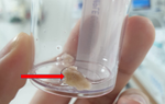 Bé trai bị suy hô hấp nặng do mảnh xương “mắc kẹt” ở đường thở