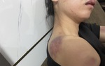 Công an truy tìm người chồng tra tấn vợ "thừa sống thiếu chết" ở Yên Bái