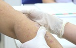 Bùng phát bệnh vảy nến do ảnh hưởng của dịch Covid-19 