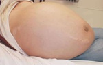 Nguyên nhân, triệu chứng và cách điều trị bệnh xơ gan cổ trướng