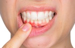 Cách chữa viêm lợi chân răng và những lưu ý trong điều trị