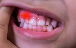 Những điều cần biết về tình trạng viêm nướu răng ở trẻ em