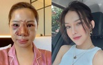 Nữ diễn viên "Chạy trốn thanh xuân" công khai quá trình "đập mặt xây lại"