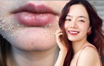 Nghe beauty blogger kể chuyện dùng Retinol/Tretinoin, chị em bớt sợ "hỏng da"
