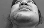 Tiêm filler trị "gò má cao", người phụ nữ phải nhập viện khẩn cấp