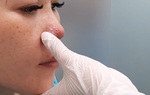 Môi phù nề, mũi có mủ sau khi tiêm filler làm đẹp