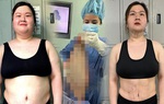 Chị em thời hiện đại giữ dáng: Ăn kiêng 0 đồng, chi trăm triệu thu nhỏ dạ dày 