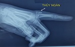 Bệnh nhi bị nhiễm độc thủy ngân do nhiệt kế đâm vào tay