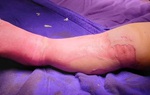 Bỏng nước sôi ở đùi và chân, gia đình đắp lá thuốc khiến trẻ tử vong