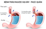 Nhiều người nhầm lẫn hội chứng trào ngược thực quản dạ dày với viêm họng