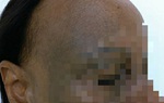 Bệnh hiếm khiến người phụ nữ 7 năm điều trị rụng tóc nửa đầu không thuyên giảm