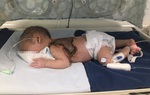Mẹ dùng kim khâu chích mụn cho con, bé sơ sinh bị nhiễm trùng huyết, hoại tử lưng