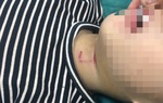 Bé 3 tuổi bị chó nhà hàng xóm cắn thủng khí quản