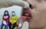 Mua son 23.000đ trên mạng xã hội, môi bé 15 tuổi dị ứng, rỉ máu