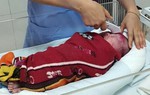 Em bé nguy kịch vì mẹ đẻ tại nhà, cắt rốn bằng rau thái rau