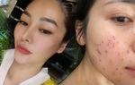 Linh Chi, Hòa Minzy mặt chi chít tổn thương, "cắn răng" chịu đau vì một làn da láng mịn