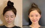 Cơn sốt phẫu thuật để có "tai yêu tinh" trong giới trẻ Trung Quốc