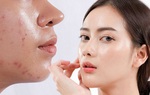 Cách chọn kem chống nắng cho da dầu mụn để cuối ngày da vẫn khô ráo