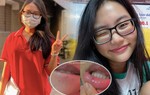 Thi cử căng thẳng, Phương Mỹ Chi chụp cận cảnh làn da "toang mạnh" ai nấy đều thương