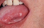 Cách phân biệt giữa nhiệt miệng và ung thư lưỡi