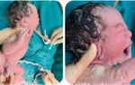 Phú Thọ: Cứu sản phụ dọa vỡ tử cung trên sẹo mổ cũ, suy thai cấp