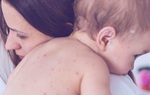 Nguyên tắc và phác đồ điều trị bệnh sởi