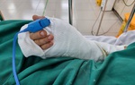 Nối thành công bàn tay người đàn ông bị chém đứt lìa