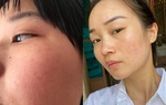 Làn da xuất hiện 5 dấu hiệu này chứng tỏ bạn bị kích ứng với mỹ phẩm đang dùng 