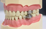 Thiết bị giảm cân "độc lạ" khiến người sử dụng không thể há miệng quá rộng