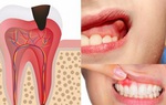 Phẫu thuật cắt chóp răng là gì? Cắt chóp răng có nguy hiểm không và bao lâu thì lành?