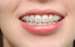 Tìm hiểu 4 bước trong quy trình niềng răng 