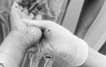 Cấp cứu cụ bà 69 tuổi gần đứt lìa cẳng tay, chuyên gia tư vấn cách bảo tồn chi khi xảy ra tai nạn