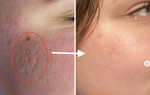 Tăng sinh collagen cho làn da theo lời khuyên của chuyên gia da liễu