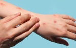 Người dân không nên quá lo lắng khi Việt Nam ghi nhận ca bệnh đậu mùa khỉ thứ hai