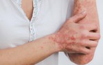 4 loại vitamin nên bổ sung để kiểm soát bệnh vảy nến vào mùa lạnh