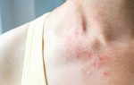 Phân biệt viêm da cơ địa và chàm